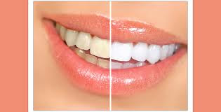 teeth bleaching