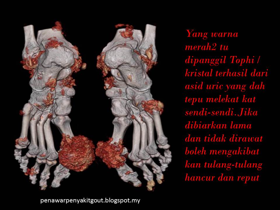 Penawar Penyakit Gout: Penawar Penyakit Gout Herba Traditional