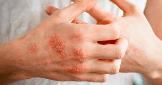 Remede-naturel-pour-eczema