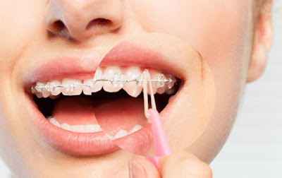 Chảy máu chân răng khi niềng răng có nguy hiểm không? 1