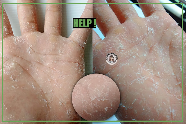 Flaking+skin+at+hands