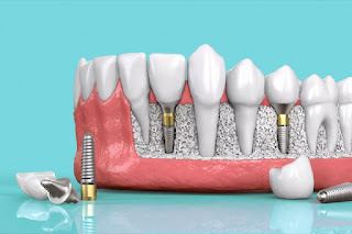 Lợi ích khi trồng răng implant trả góp-1