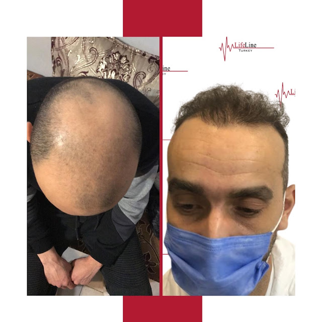 hair transplant in turkey