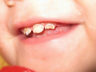 Răng hàm bị mẻ có hàn được không? 