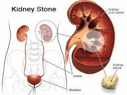 சிறுநீரக கற்களை நீக்க | Remove kidney stones!!!