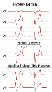 高血鉀 Hyperkalemia