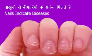 नाखूनों से बीमारियों के संकेत मिलते हैं-Nails Indicate Diseases
