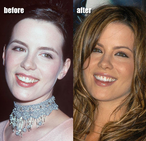 Kate Beckinsale Plastic Or Cosmetic Surgery