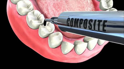 Trám răng composite có bền không? 