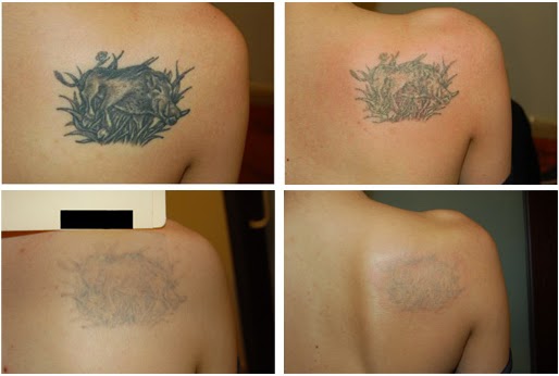  Laser Tattoo Removal Before & After