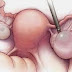 WANITA WAJIB TAHU !! TANDA - TANDA FIBROID DAN CYST DALAM RAHIM YANG BERMASALAH