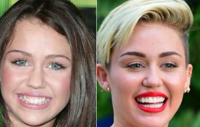 Miley Cyrus before and after cosmetic surgery