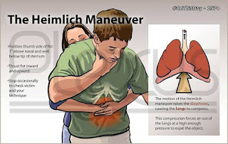Heimlich maneuver