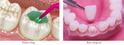 Xử lý răng sâu hay bị chảy máu theo cách an toàn-2