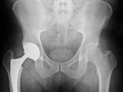 Symptoms of wear of hip and its prevention 