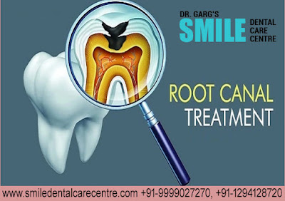 Painless Root Canal Treatment in Faridabad