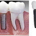 Trồng răng mất bao lâu với phương pháp implant