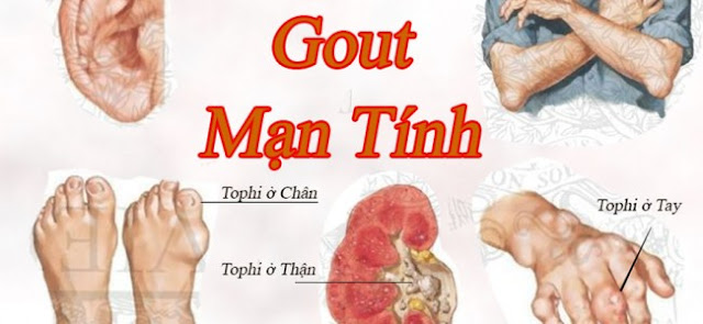 gút mạn tính khiến các khối u trở nên dị dạng