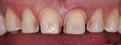 Quy trình tiến hành mặt dán răng sứ veneer