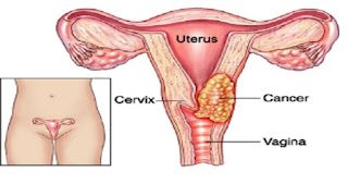 Pictures Of Cervical Cancer3