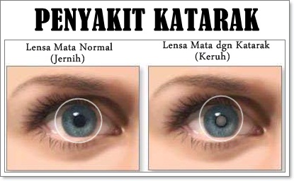 Pulihkan Penyakit Katarak Tanpa Pembedahan Elak Mata 