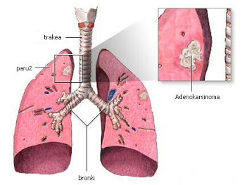 Lung Cancer, pulmonary and respiratory tract Diseases