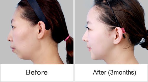 짱이뻐! - Korean Two Jaw Surgery & Cheekbone Reduction for Younger Looks