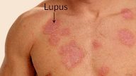 Get Rid Of Red Bumps On Face