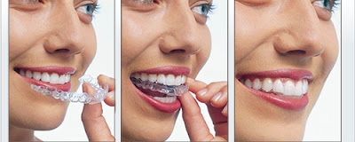 Áp dụng niềng răng bằng nhựa dẻo cho người bận rộn-2