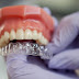 Niềng răng không mắc cài 3D Clear có ưu điểm gì?