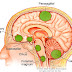 Brain Tumor - Types, Symptoms, and Causes
