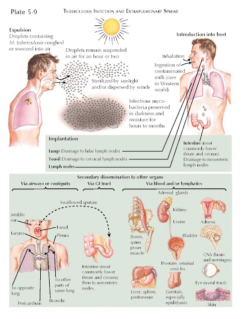 TUBERCULOSIS INFECTION AND EXTRAPULMONARY SPREAD