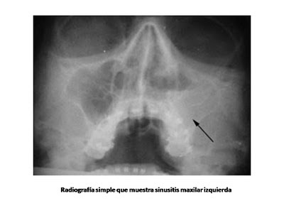 Sinusitis maxilar