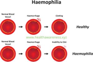 What is hemophilia