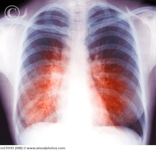 Rculosis On Chest X Ray