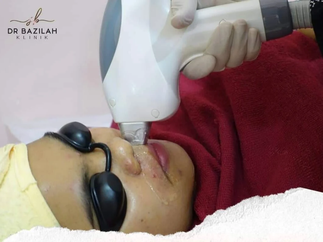 Rawatan 'Hair Removal Laser' Klinik Dr Bazilah Atasi Masalah Bulu Berlebihan Wanita. Selamat dan Tidak Menyakitkan