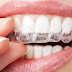 Invisalign và eCligner là 2 đại diện của niềng răng trong suốt