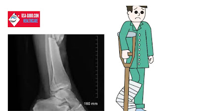 What is Broken leg?