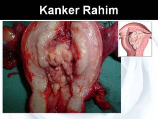 jual obat ampuh kanker rahim parah, obat alami kanker rahim, pengobatan alami kanker rahim