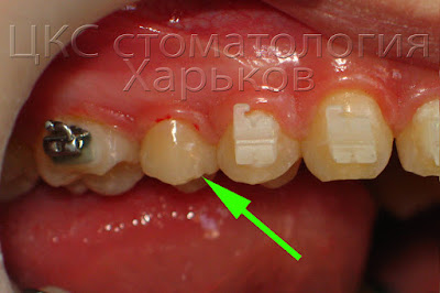 Вид зуба после отклеивания брекета по вине врача