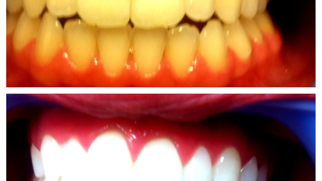 Before And After Professional Teeth Whitening
