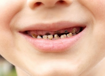 Nguyên nhân mất răng là gì?