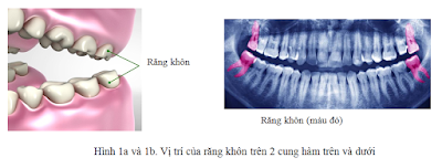 Răng khôn làm lệch mặt do nguyên nhân gì?