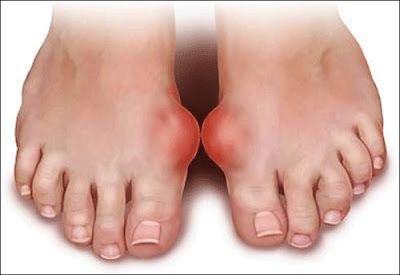 Biểu hiện bệnh gout là đau và sưng đỏ