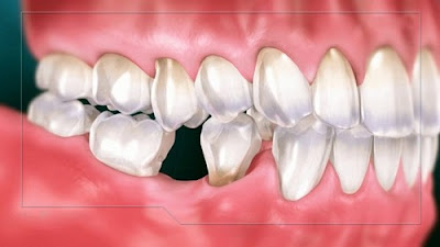 Trồng răng số 7 bằng phương pháp cấy ghép implant-2