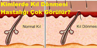 Kimlerde Kıl Dönmesi Hastalığı Çok Görülür?