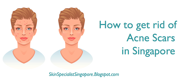 Acne scar treatment Singapore