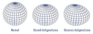 Astigmatizmalı Göz