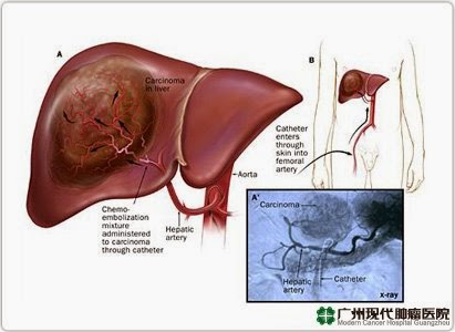 Cara menyembuhkan penyakit tumor hati