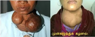 முன் கழுத்து கழலை - கண்டக் கழலை - Goiter.